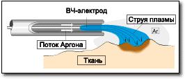 Принцип аргон плазменной коагуляции