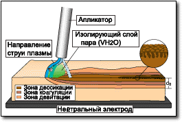 принцип аргон-плазменной коагуляции